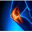 Shockwave For Knee Arthritis  Leading Edge Physiotherapy St Albert