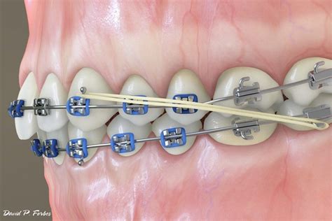 Orthodontic Tooth Movement Forbes Orthodontics