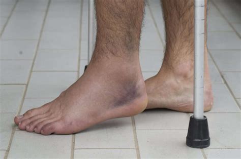 Swollen Ankle After Knee Replacement 8 Best Treatments