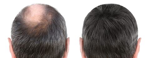 Pourquoi se déplacer en Turquie pour d'implant de cheveux?