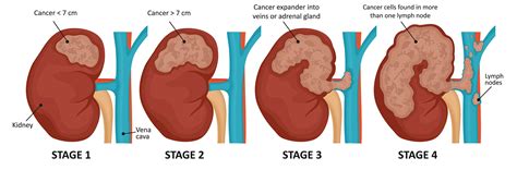 Kidney Cancer Signs And Symptoms Austin Texas