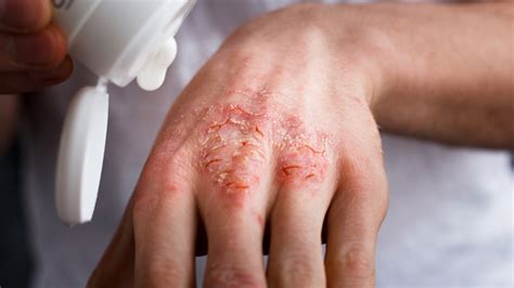 Dermatologists Advice On Managing Seborrheic Dermatitis Treatments