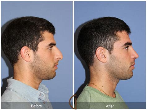 male rhinoplasty before and after photos from dr kevin sadati