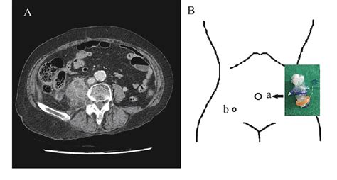 Figure 2 From Treatment Of Appendicitis With Iliopsoas Abscess By