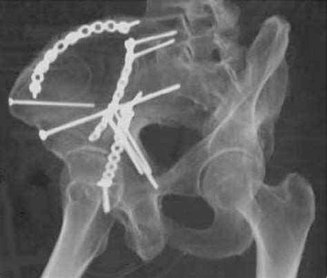Pelvic Fracture Fixation