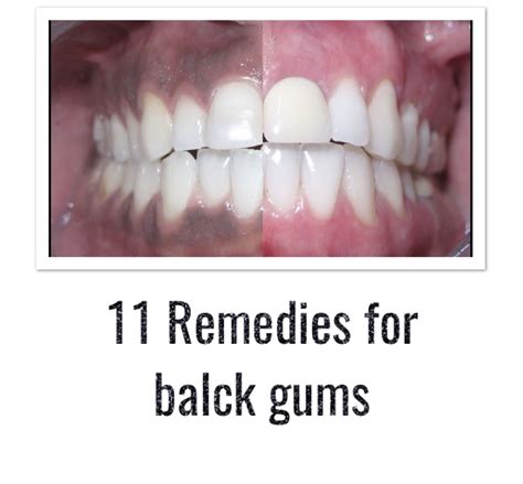 11 Remedies For Black Gums Natural Care Skin Care Recipes Black