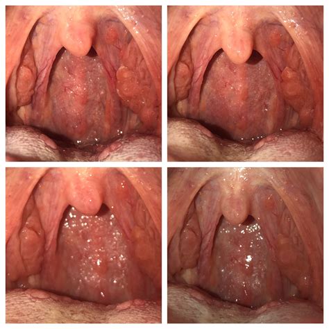 Throat Issues For 2 Months Can Anyone Figure This Out Diagnoseme