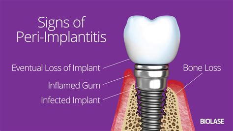 Peri Implant Disease Management With Waterlase Dental Lasers Biolase
