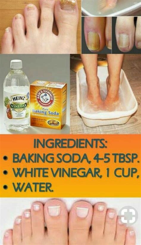 Pin By Mary Mck On Health And Beauty Foot Remedies Dry Feet Remedies