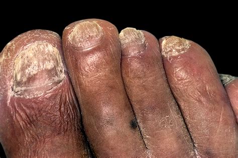 Fungal Nail Infection Nhs