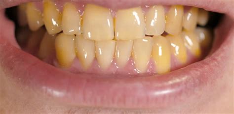 What Causes Yellow Teeth Dr Miski
