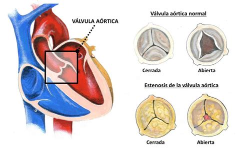 Estenosis Valvula Aortica Cardiosaudeferrol