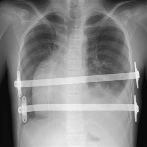 Postoperative Chest X Ray Showed Right Pneumothorax A