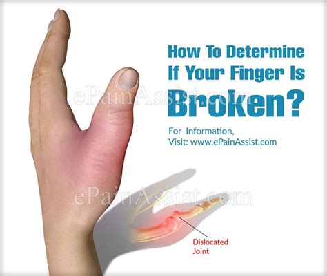 The fingers are the most frequently injured part of the hand. How To Determine If Your Finger Is Broken & Ways To Manage ...