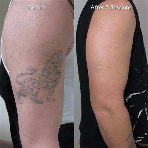 Vol 2 Best Of 2021 Before And After Tattoo Removal Results Removery