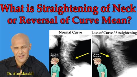 What Is Straightening Of Neck Or Reversal Of Curve Mean Dr Mandell