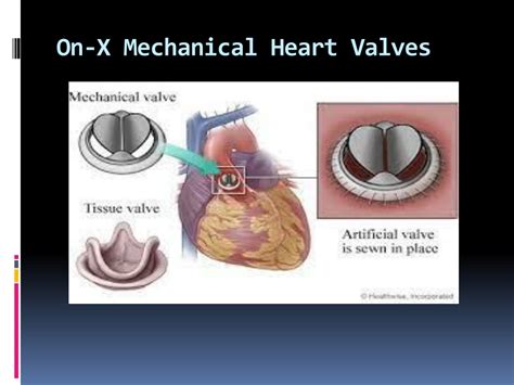 Ppt On X Mechanical Heart Valves Powerpoint Presentation Free