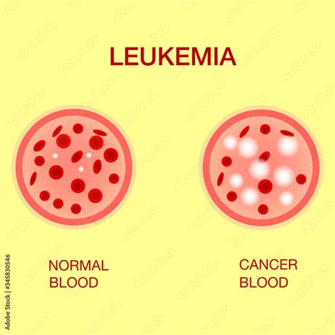 Plakat Infographic Image Of Leukemia Leukaemia Disease Awareness