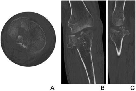 Tibial Plateau Fractures In Elderly Patients Joshua C Rozell
