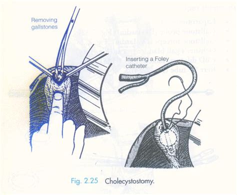 Otmanage Procedure Cholecystostomy