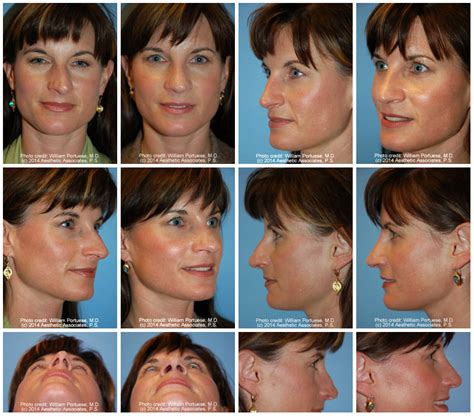 Crooked Nasal Bones Before And After Photo Gallery Nose