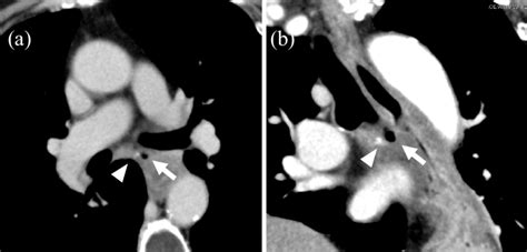 Figure2computed Tomography Ct Revealed The Mid Esophageal Download Scientific Diagram