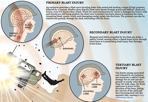 Brain Wars How The Military Is Failing Its Wounded Dart Center