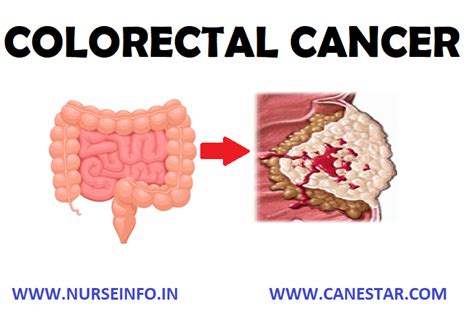 Colorectal Cancer Nurse Info