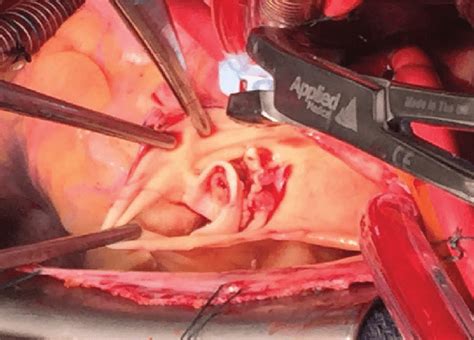 Subpulmonic Valve Stenosis And Pv Vegetation During Open Heart Surgery