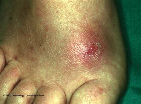Skin Infections Cellulitis