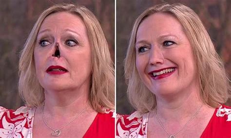 Woman Reveals How She Wears A False Nose After Her Face Collapsed