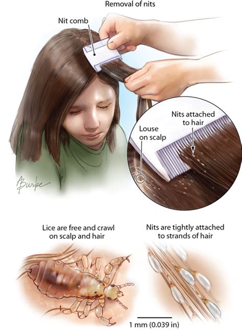 Head Lice Dermatology Jama Jama Network