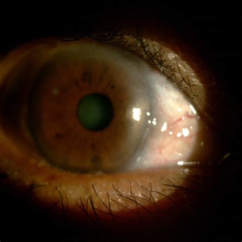 Superficial Punctate Keratitis Seen In A Patient With Ocular Rosacea