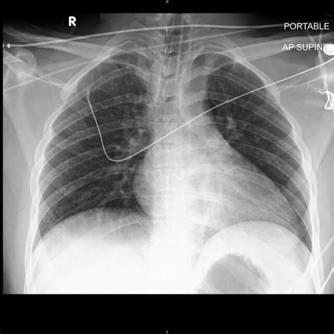 Chest X Ray Portable Shows Unremarkable Study Download Scientific