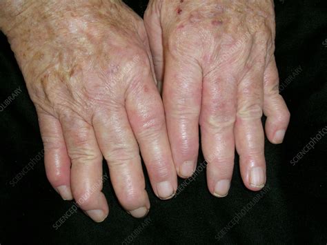 Rheumatoid Arthritis Nodules Stock Image C0565085 Science Photo