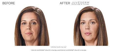 JuvÉderm Before And After Real Patient Results