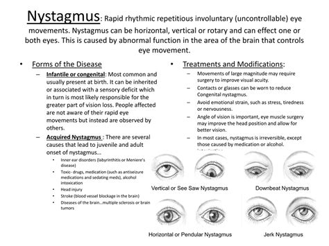 Eye Nystagmus Causes Types Signs Symptoms Test Nystagmus Treatment Vrogue