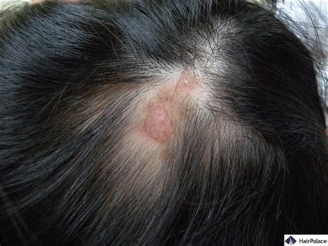 Lupus Hair Loss Causes Symptoms And Treatment Options