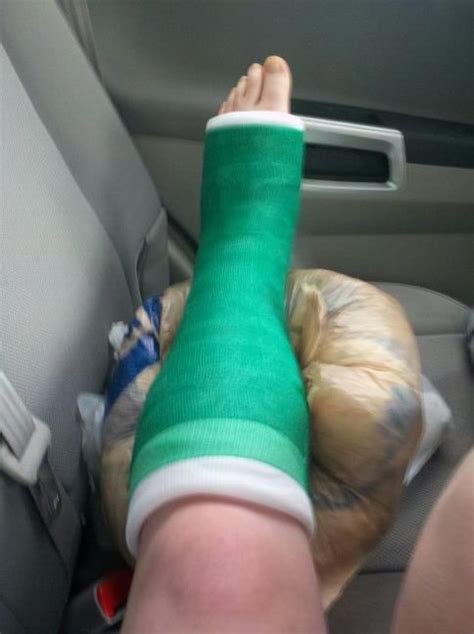 Cast Broken Leg Quotes Quotesgram