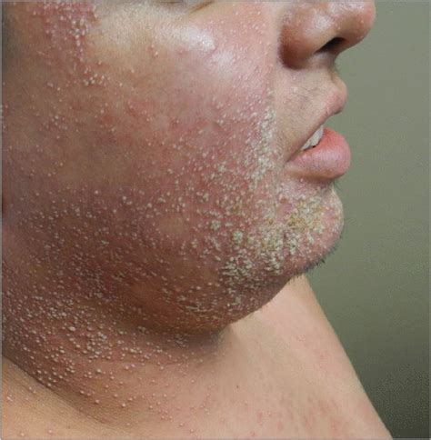 Fever And A Pustular Rash Dermatology Jama Jama Network