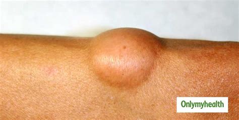 Bumps On The Skin Can Be Signs Of Lipoma Know Everything About This
