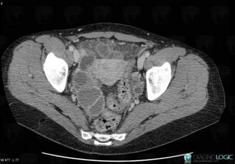 Radiology Case Tubo Ovarian Abscess CT Diagnologic