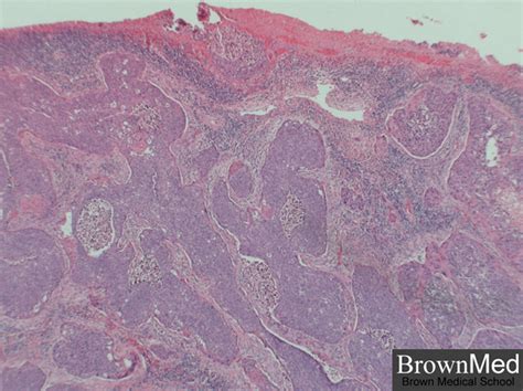 Moderately Differentiated Squamous Cell Carcinoma Pictures Photos