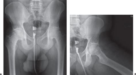 Flat Wedged Taper Femoral Components Musculoskeletal Key
