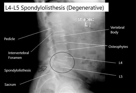 Spondylolisthesis Complete Orthopedics Multiple Ny Locations