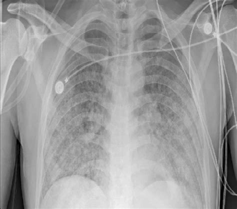 Chest X Ray Of The No 6 Patient Shows Bilateral Infiltrates In Upper