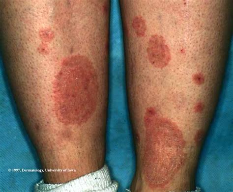 Skin Rash On Leg Pictures Pictures Photos