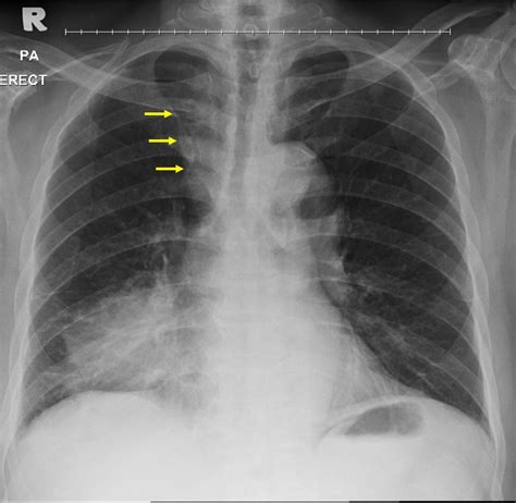Lung Cancer Squamous Cell Carcinoma Radiology Cases