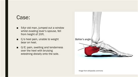 Lover's Fracture — learnED