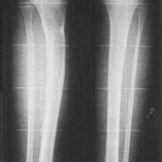 Case 10: fracture of the proximal tibia1 metaphysis with ...